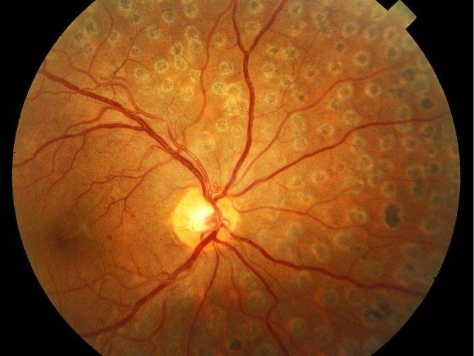 Причины и лечение ангиопатии сетчатки глаз у ребенка