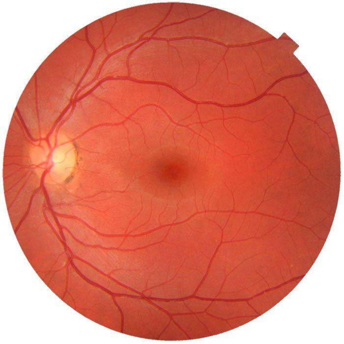Ретробульбарный неврит зрительного нерва: симптомы и лечение