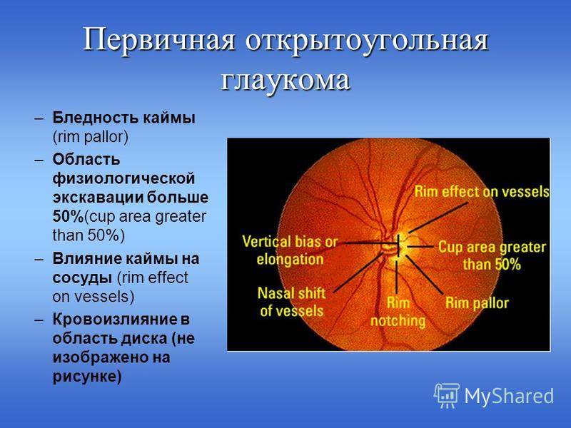 Симптомы и лечение глазного давления