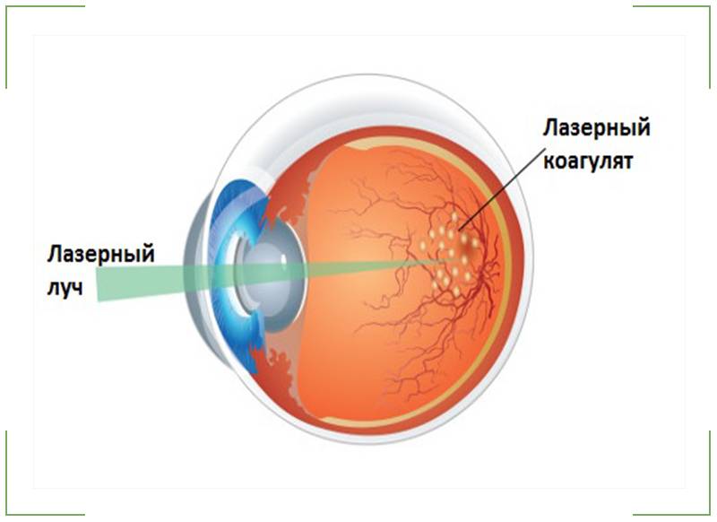 Лазерная коагуляция сетчатки глаза: как делается и когда назначается | food and health