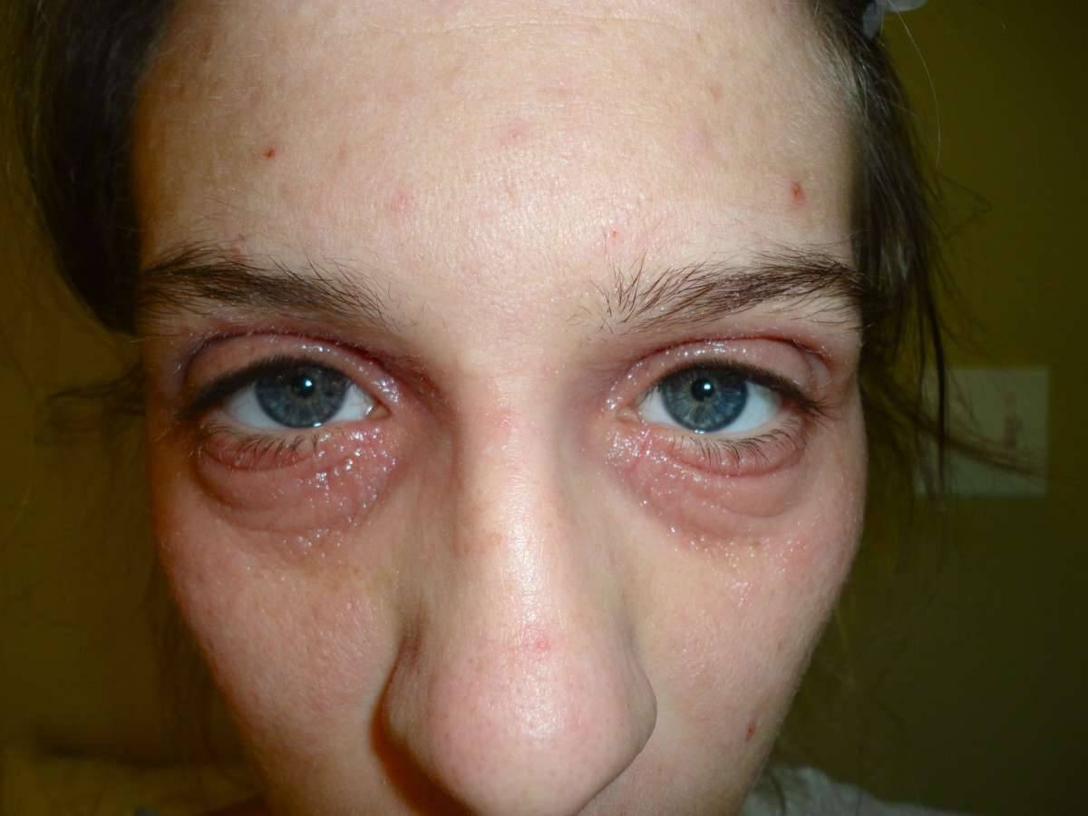 Причины аллергии на глазах и быстрое, эффективное лечение