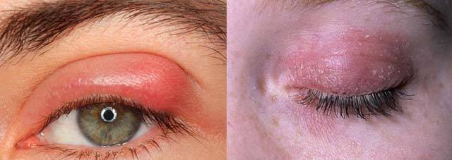 Покраснение вокруг глаз у ребенка и взрослого: причины и способы лечения в домашних условиях