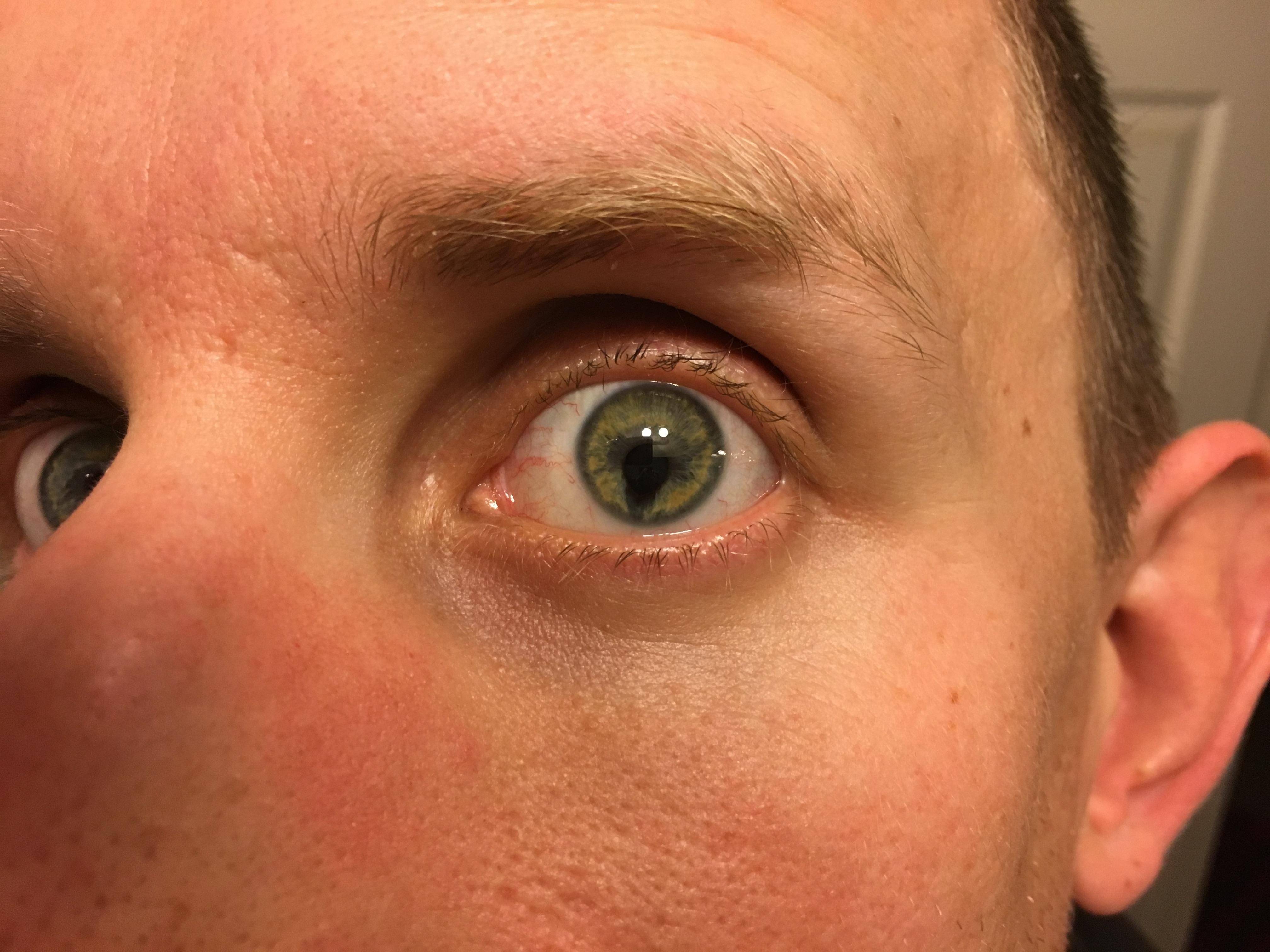Поликория глаза (двойной зрачок) - причины и принципы лечения