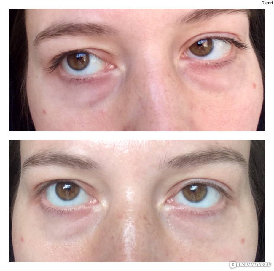Как убрать синяки под глазами? лечение и средства против синих кругов под глазами