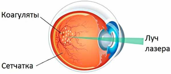 Лазеркоагуляция сетчатки глаза: как проводят, последствия, стоимость