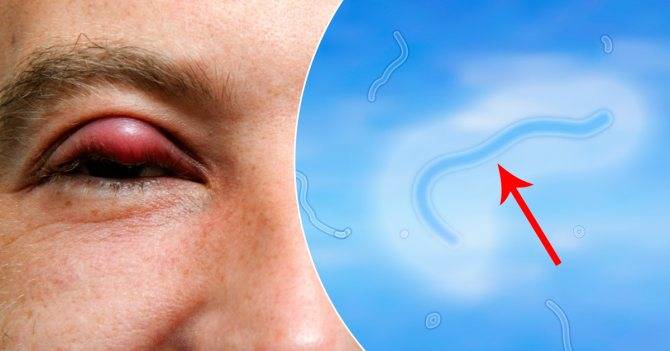 Пятно в глазу: причины появления, симптомы, терапия