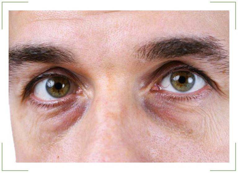 Мешки под глазами: причины у мужчин, почему черные или синие круги, что означают сильные проявления, как избавится