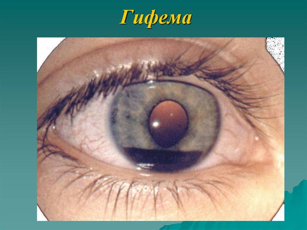 Фото гифемы глаза — как выглядит заболевание и в чем его опасность? проведение лечения