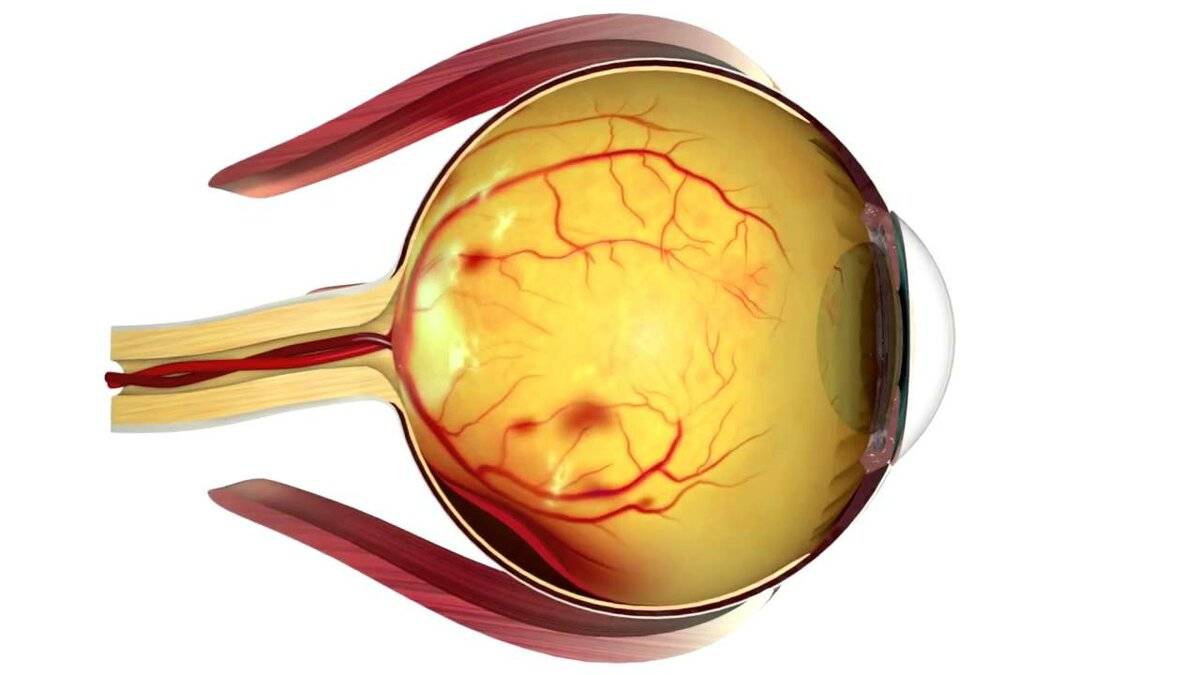 Диабетическая ретинопатия - что это, причины, симптомы, лечение