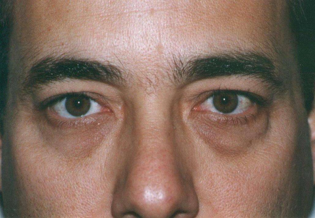Тёмные круги под глазами у мужчин: причины, лечение oculistic.ru
тёмные круги под глазами у мужчин: причины, лечение