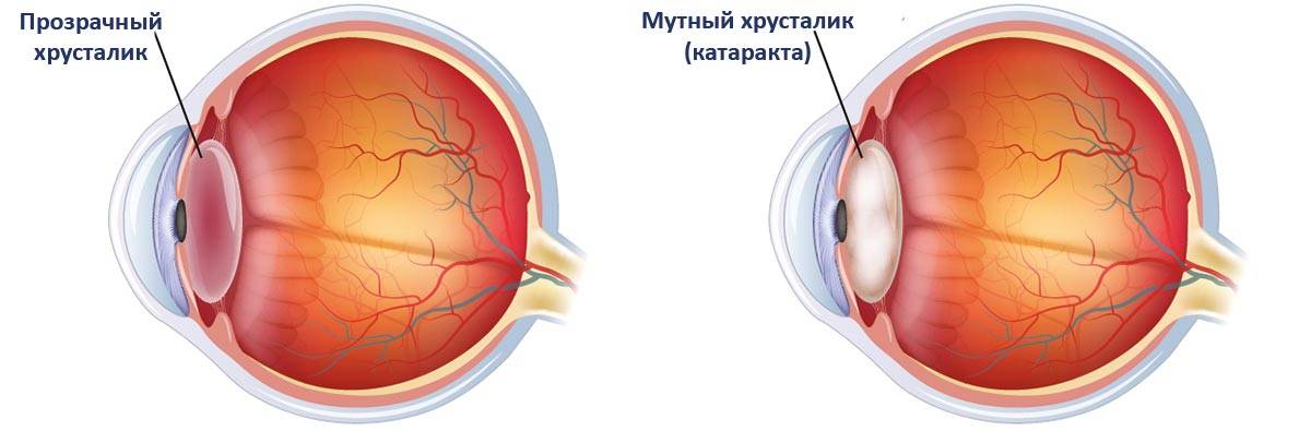 10 видов катаракты и основные принципы лечения