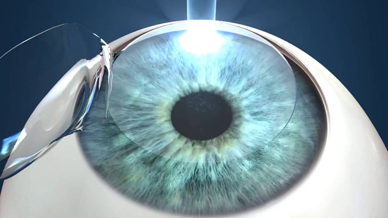 Коррекция зрения методом ласик или фрк: что лучше, безопаснее и эффективнее