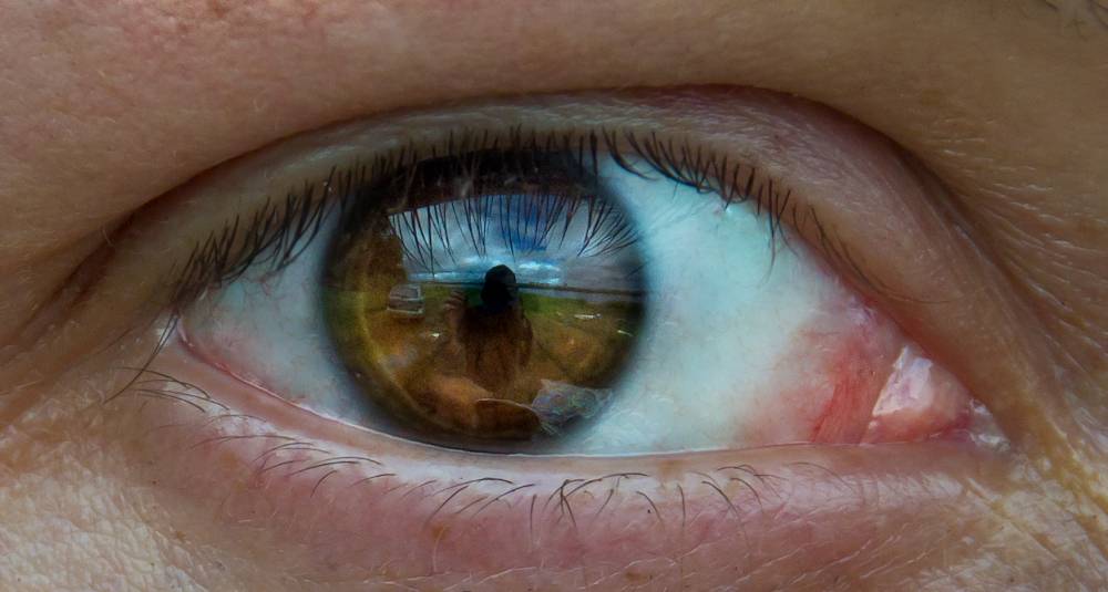 При каких заболеваниях желтеет кожа и белок глаз?