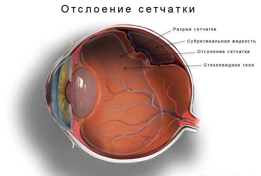 Операция при отслоении сетчатки глаза: методы, показания, реабилитация