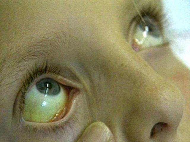 Причины желтых белков глаз у новорожденных