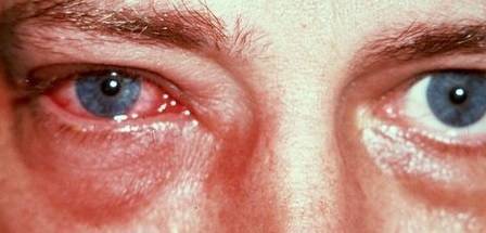 Вирусный конъюнктивит у взрослых: причины, симптомы, лечение, препараты для терапии острой энтеровирусной инфекции глаз