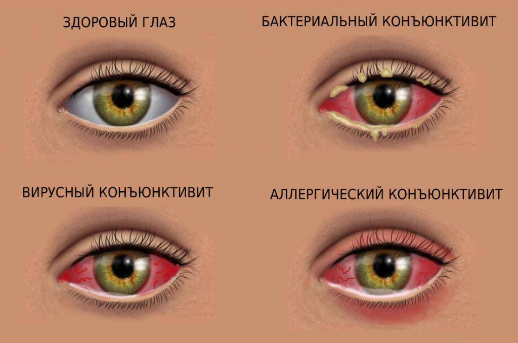 Инфекционный конъюнктивит: причины, симптомы, лечение - "здоровое око"