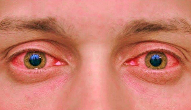 Как избавиться от красноты глаз в домашних условиях: что делать, если красные органы зрения слезятся, как лечить, у взрослого