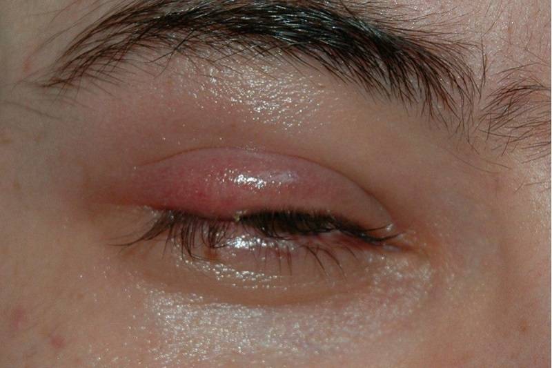 Киста на глазу: симптомы (фото), причины, что делать и как лечить у взрослого или ребенка, удаление, осложнения, профилактика