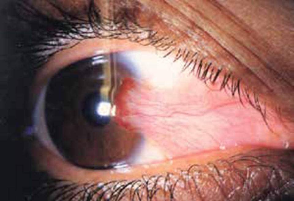 Птеригиум (птеригий, крыловидная плева) глаза: что это такое, степени, лечение (в том числе народными средствами), в каких случаях необходима операция и другие аспекты