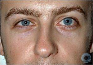Почему один глаз больше другого и как это исправить: причины, лечение