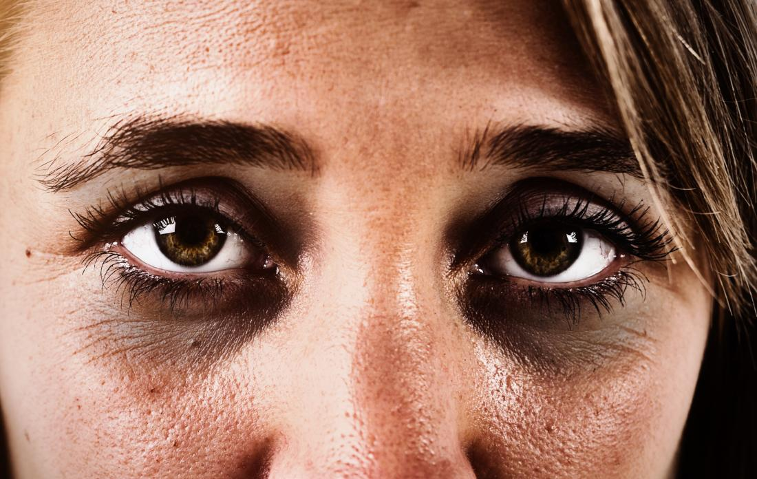Причины темных кругов вокруг глаз у женщин. лечение в домашних условиях
