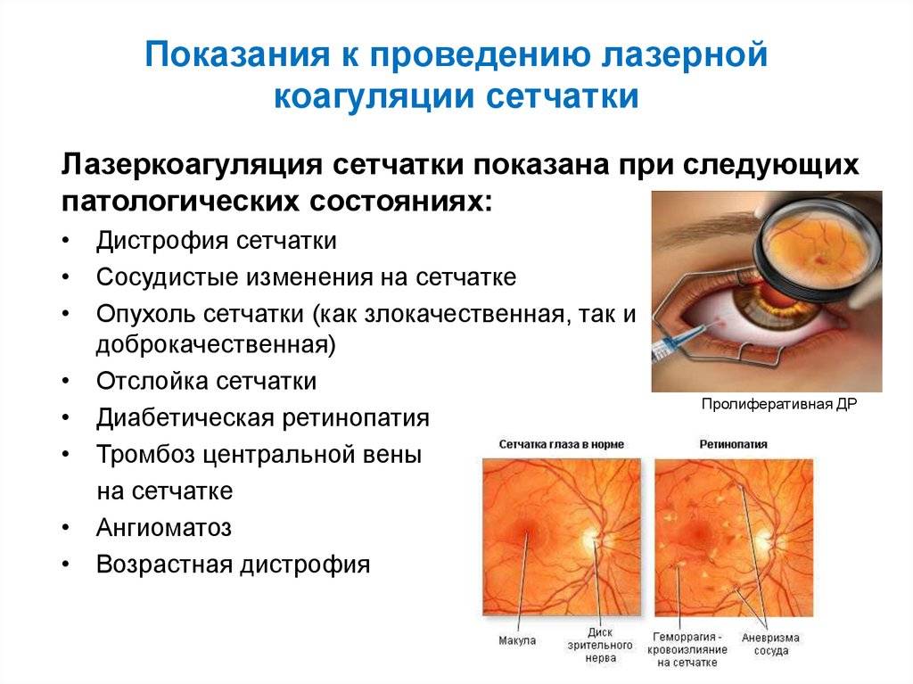 Особенности проведения лазерной коагуляции сетчатки глаза