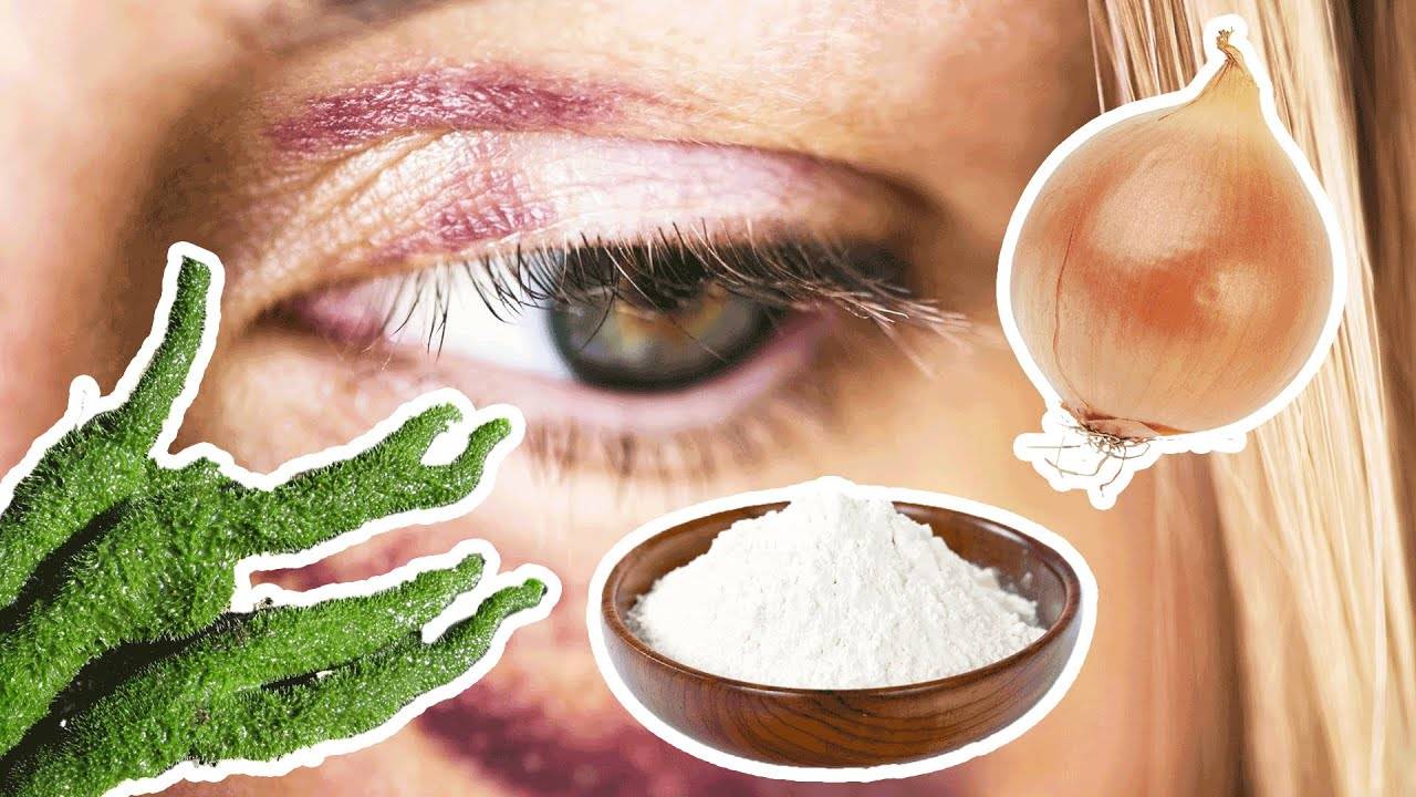 Методы быстрого избавления гематомы глаза после удара: лечение медикаментами и народными средствами