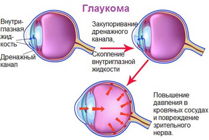 Признаки глаукомы. что такое глаукома, лечение
