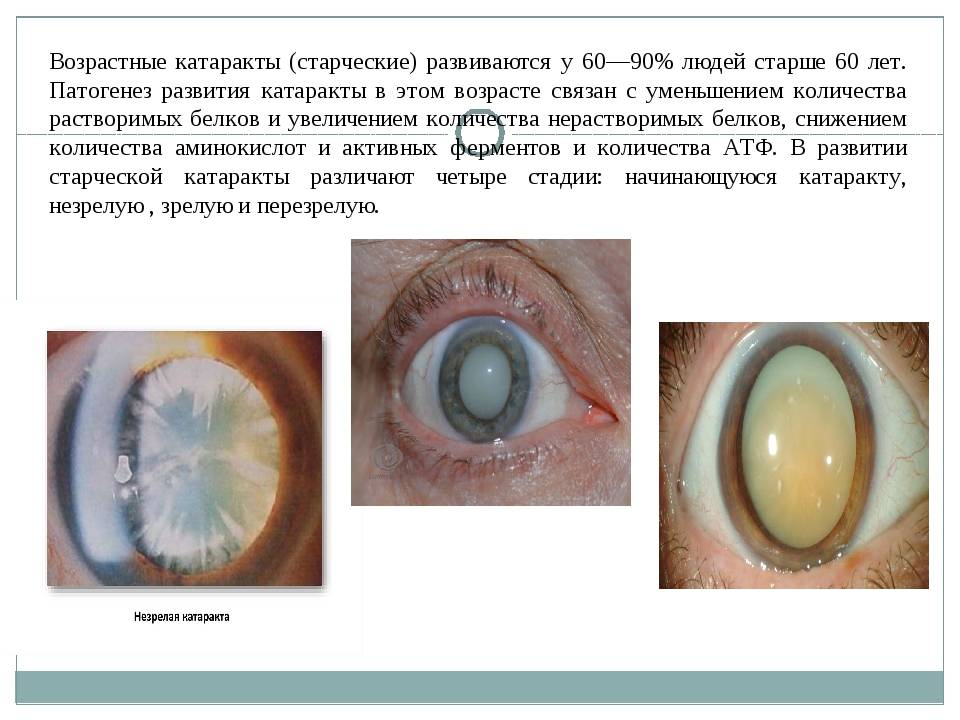 Катаракта – причины, виды, симптомы и признаки, диагностика помутнения хрусталика глаза, осложнения