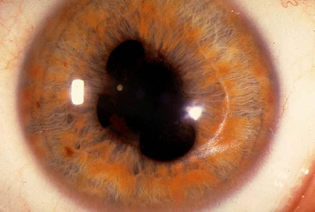 Что это такое - глазное заболевание иридоциклит