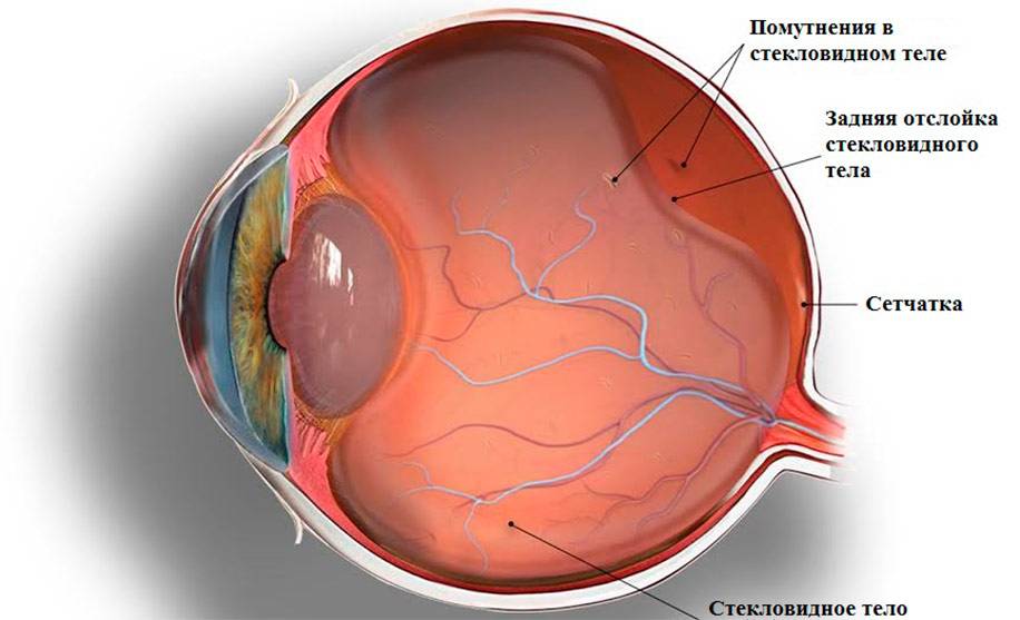 Эпиретинальный фиброз сетчатки, причины, симптомы, лечение - "здоровое око"