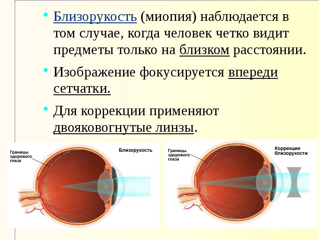 Как восстановить зрение при близорукости - простые методики