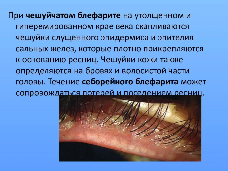 Хронический блефарит обоих глаз: причины, симптомы, лечение (препараты, народные средства), диагностика, профилактика