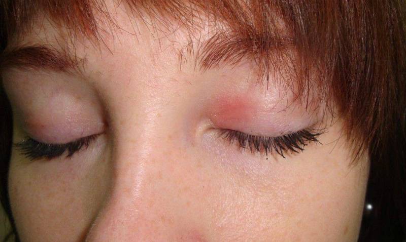 Круги вокруг глаз красные причины. причины возникновения красных пятен или кругов под глазами у взрослых