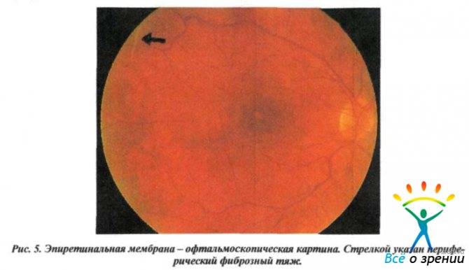 Что такое эпиретинальная мембрана глаза и чем она опасна для зрения