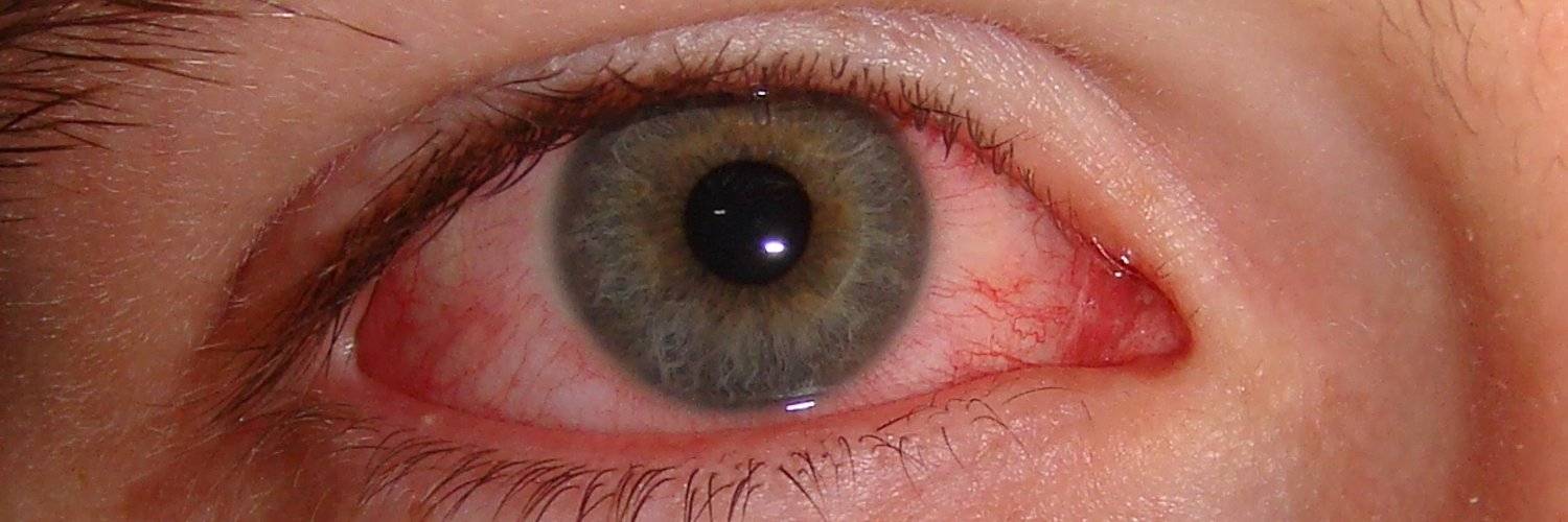 Сопутствующие симптомы и диагностика ожога роговицы глаза