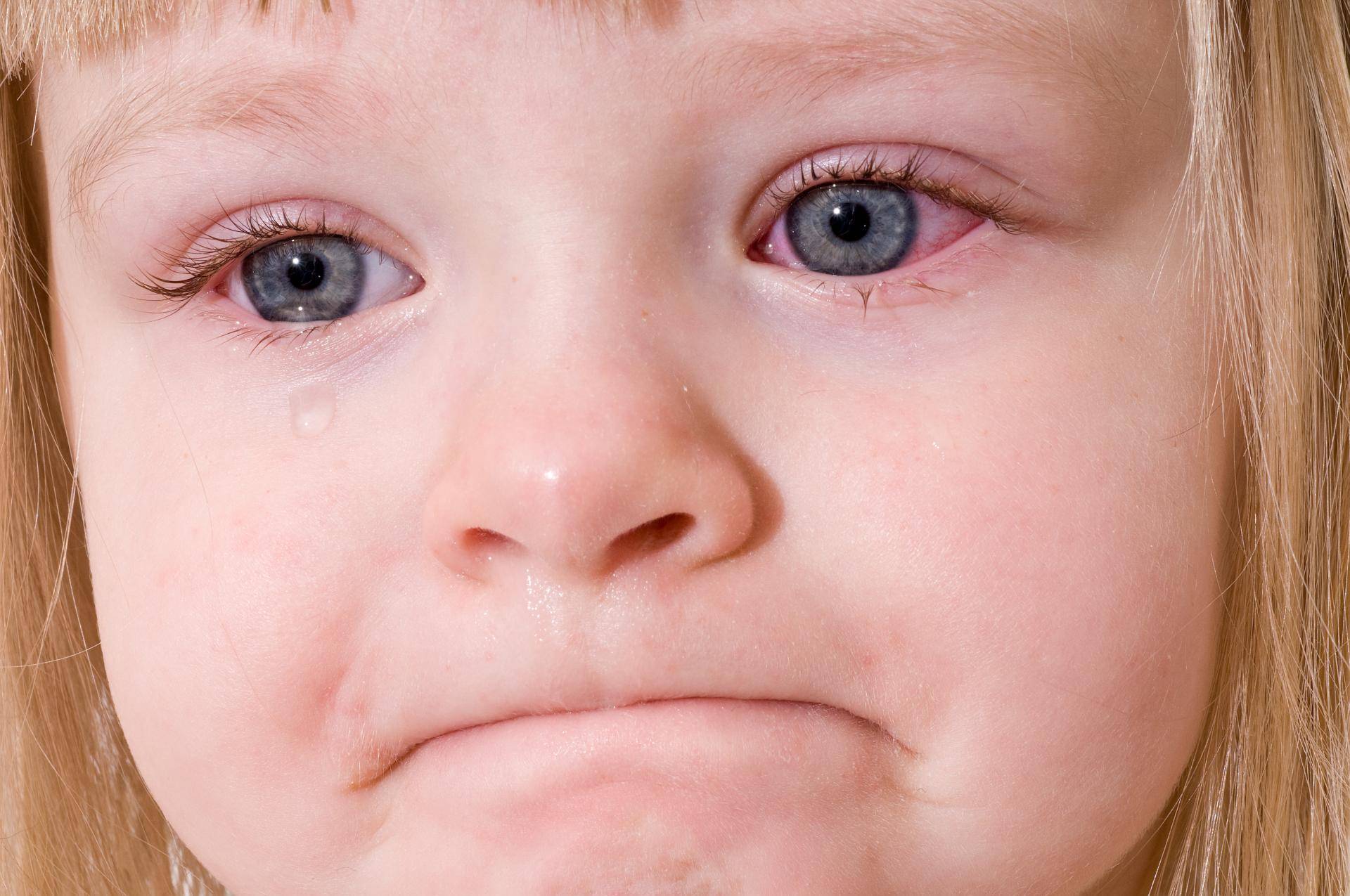 Аллергический конъюнктивит у ребёнка: симптомы, фото, лечение в домашних условиях