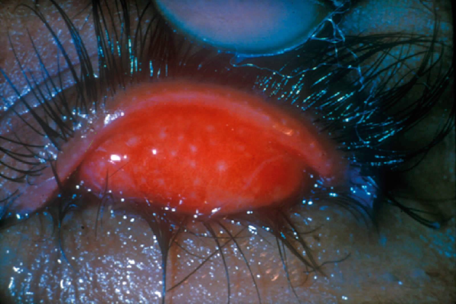 Трахома глаз – что это, лечение, причины и симптомы, фото