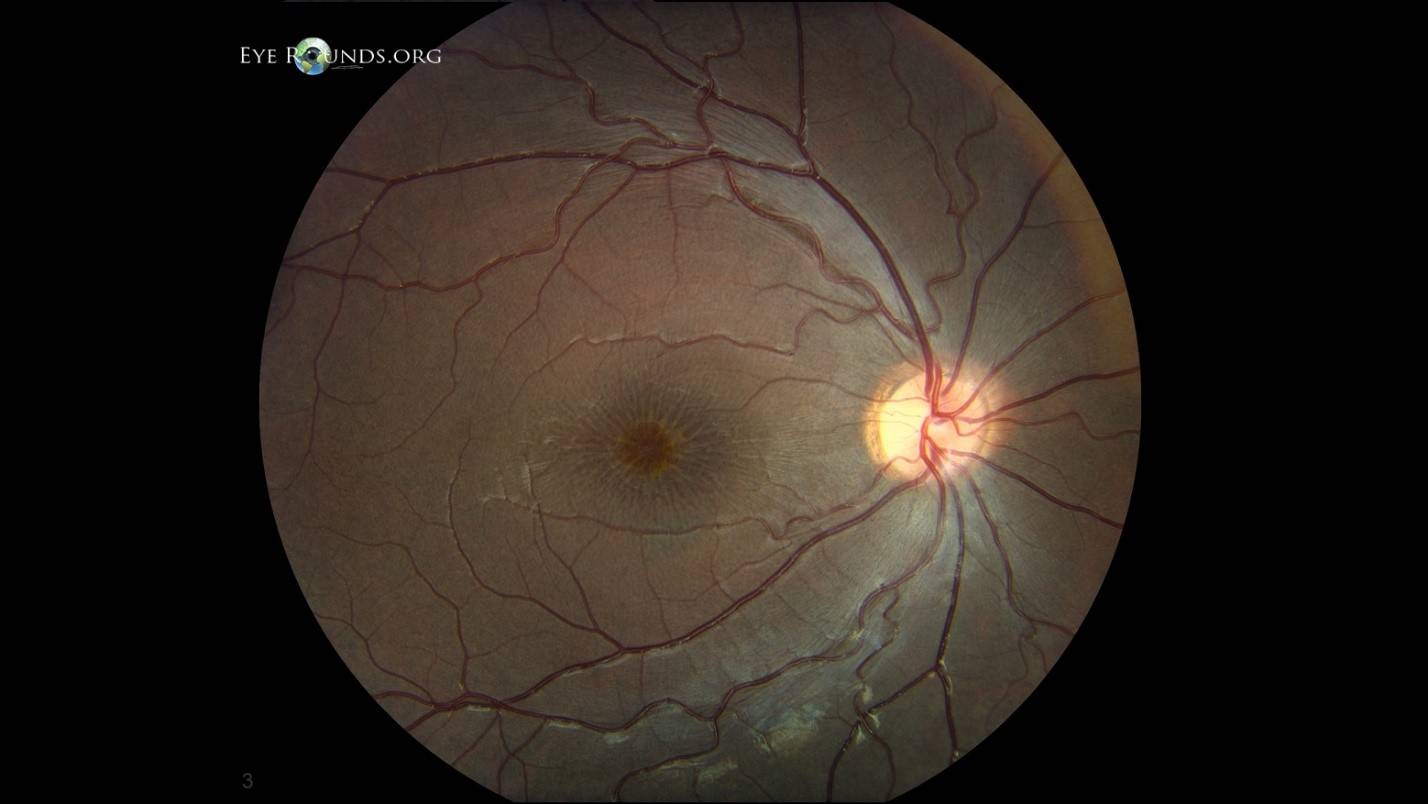 Разрыв сетчатки глаза - причины, симптомы, лечение и операция