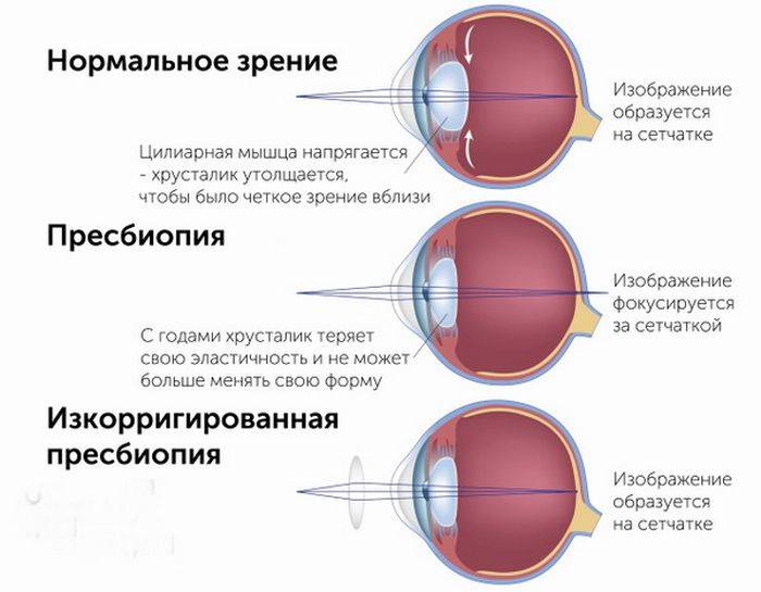 Особенности возрастной дальнозоркости | про болезни глаз