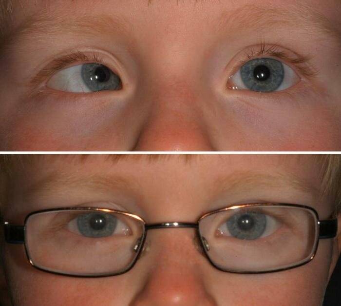 Какой глаз в рецепте на очки обозначается od и какой — os