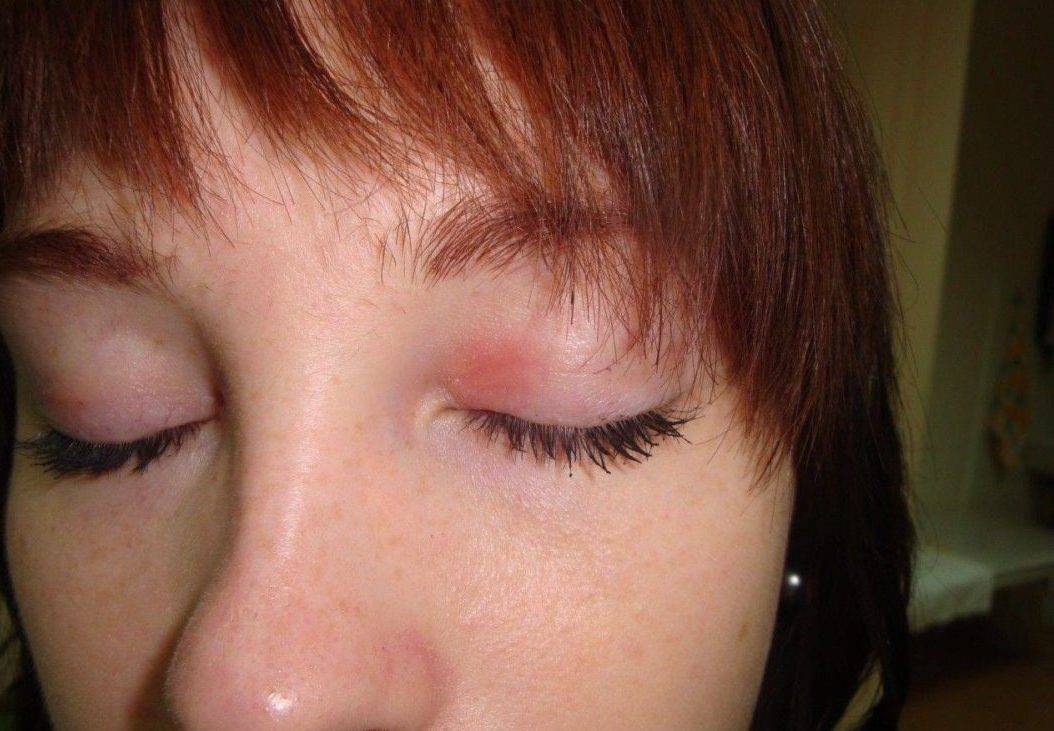 Как лечить дерматит вокруг глаз