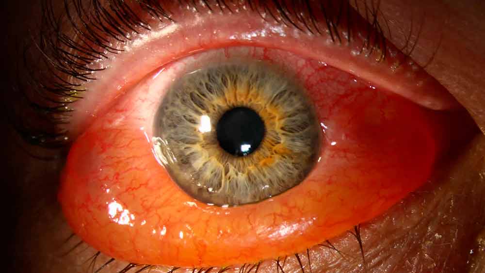 Увеит глаза: симптомы и лечение переднего, заднего увеита