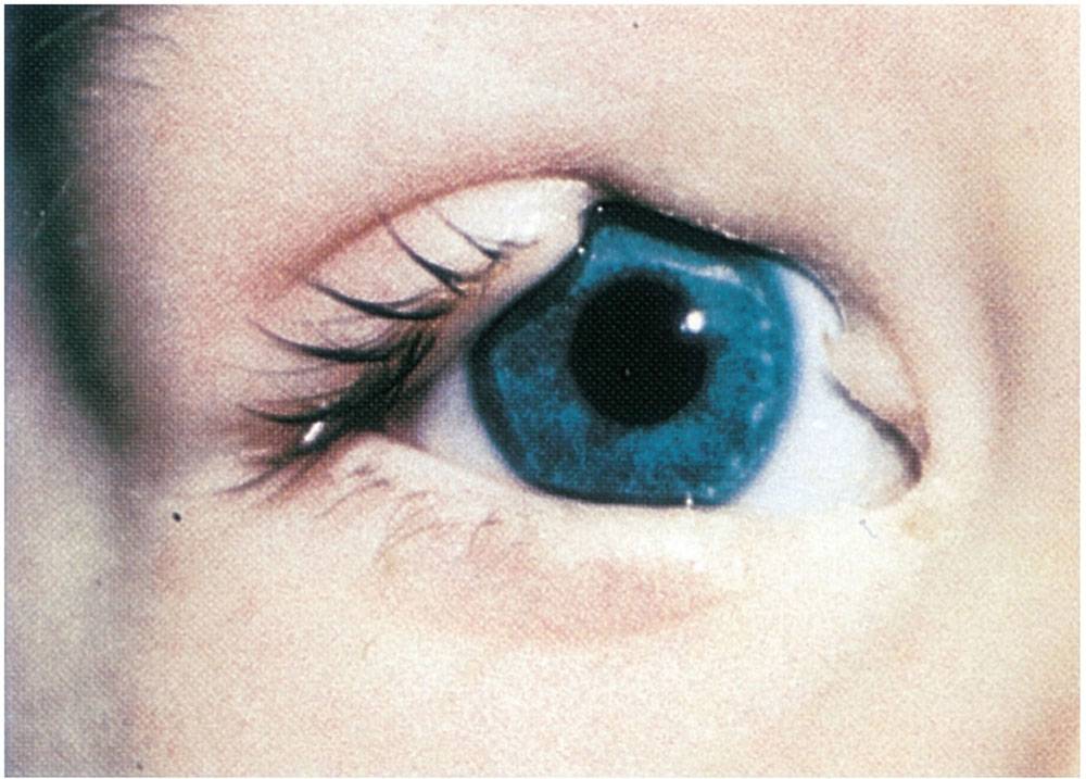 Колобома глаза: что это? лечение болезни