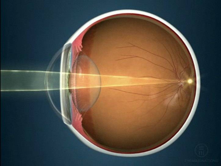 Три варианта коррекции зрения при близорукости: оптическая, лазерная, хирургическая