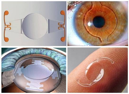 Имплантация иол (интраокулярные линзы) – искусственный хрусталик глаза – клиника новый взгляд в москве