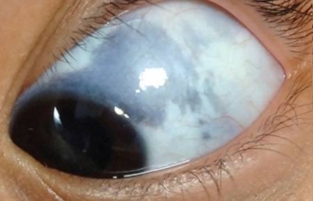 Причины появления и последствия красного пятна на глазном яблоке
