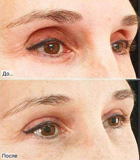 Вытек глаз - как происходит вытекание, первая помощь