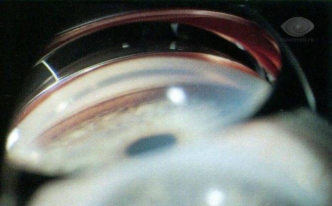 Виды обследований для диагностики глаукомы с описанием и фото